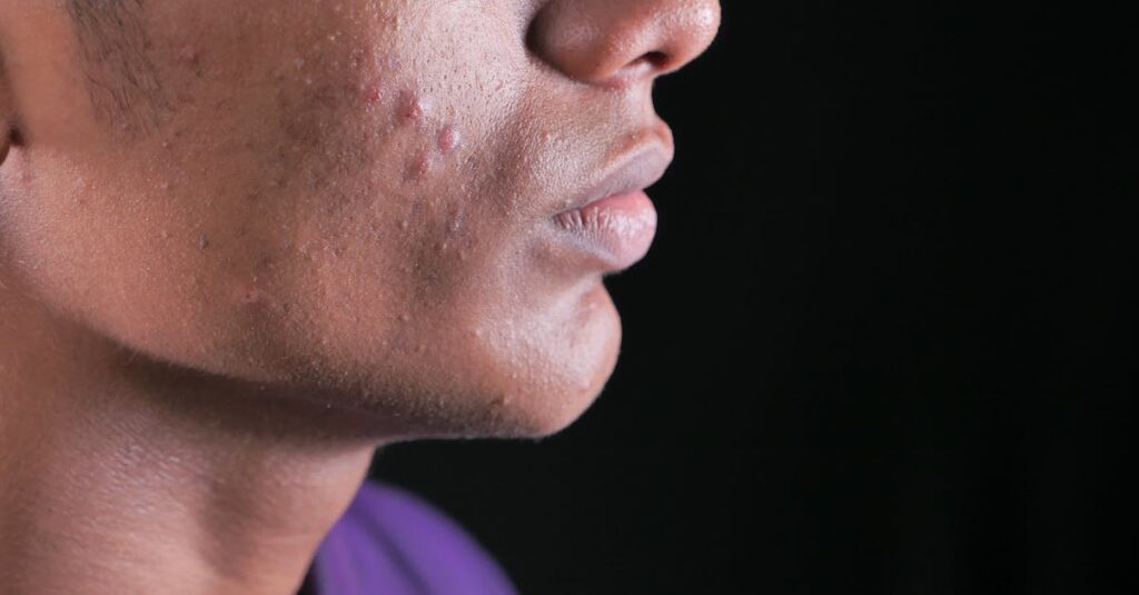 ファンケルのアクネケアたっぷりおためしキットに関するよくある質問と回答